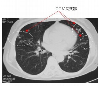 肺MAC症の胸部CT画像