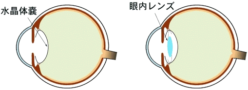 やさしい白内障のおはなし 医学小知識